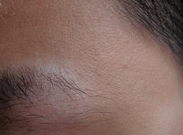 驅(qū)蟲(chóng)斑鳩菊注射液治療白癜風(fēng)