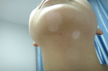 碎紙樣白癜風好治療嗎