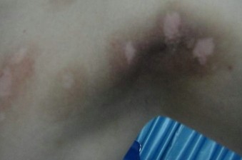 白癜風治療需要的是堅持