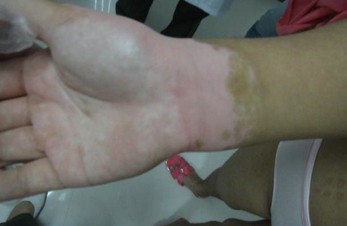 白癜風需及時治療嗎？