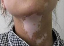 白癜風病人需要注意些什么？