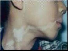 面部白癜風該如何治療好呢？