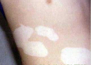 如何控制白癜風(fēng)的擴散呢