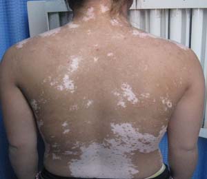 青少年白癜風如何治療好的更快呢?