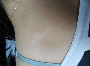 白癜風(fēng)怎樣做才可以治好呢？