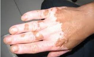 患上白癜風可怕嗎?