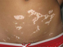 白癜風(fēng)患者常見(jiàn)的心理治療措施有哪些呢？