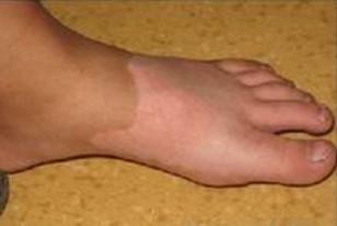 足療也可以促進(jìn)白癜風(fēng)的治療嗎?