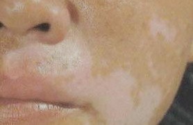 穩(wěn)定期白癜風的治療方法