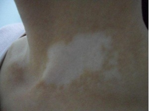 石家莊白癜風醫(yī)院專家解說白癜風治療三步走