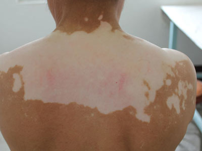 怎樣找對(duì)白癜風(fēng)治療的關(guān)鍵點(diǎn)?