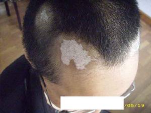 石家莊白癜風(fēng)專(zhuān)家解答頭皮上長(zhǎng)白斑應(yīng)注意些什么呢