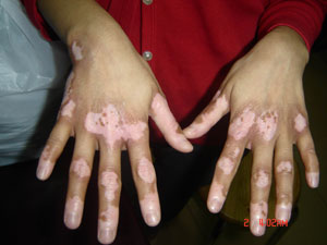 河北好的白癜風(fēng)醫(yī)院：如何治療好患者的白癜風(fēng)疾病呢？