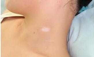 哪些食物有益于白癜風治療