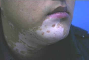 石家莊治療白癜風哪里去？白癜風能治療好嗎？