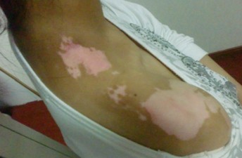 治療白癜風要堅持哪些原則?