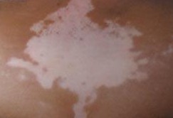 女性白癜風(fēng)護理需要注意的事項有哪些？