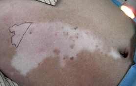 白癜風(fēng)患者的家屬應(yīng)該怎么做?