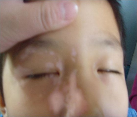 青少年白癜風(fēng)治療有哪些注意事項(xiàng)