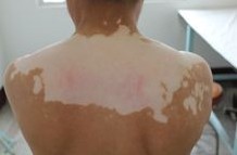 肚子上有白癜風應該怎治療呢?