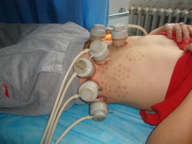 做白癜風植皮手術需幾天才能康復