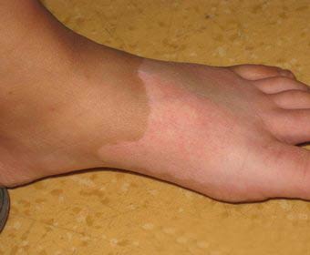 腳部白癜風(fēng)該挑選哪種醫(yī)治辦法好