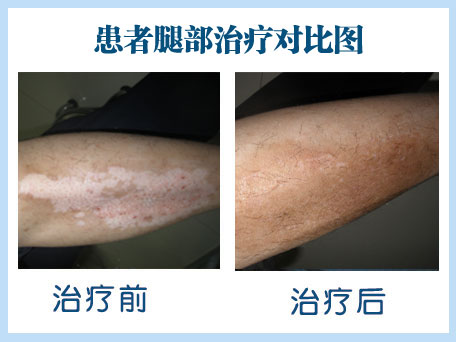 白癜風心理治療