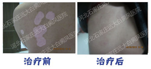 308適合治療發(fā)展期的白癜風(fēng)嗎