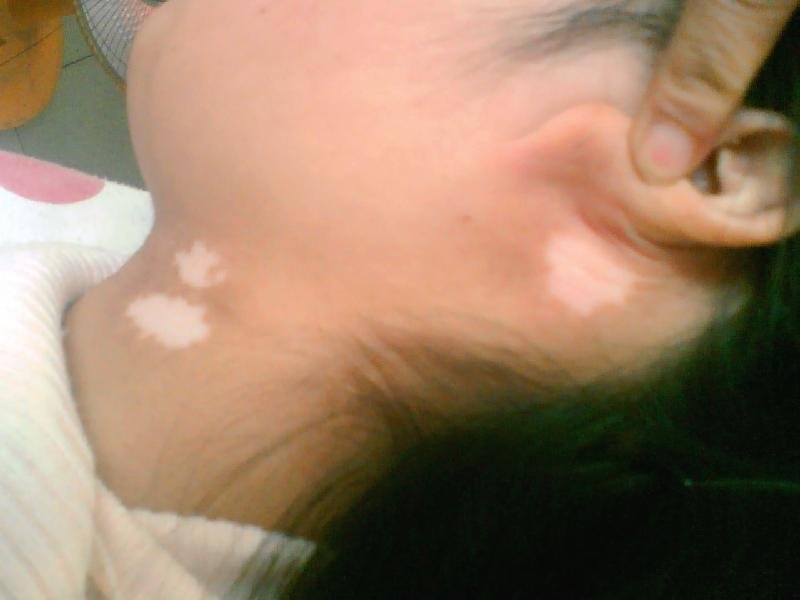 臉部的白癜風(fēng)多久能治好