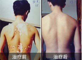 背部白癜風如何治療效果好