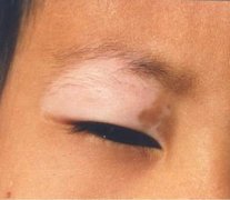 白癜風在臉上還有發展怎么治療