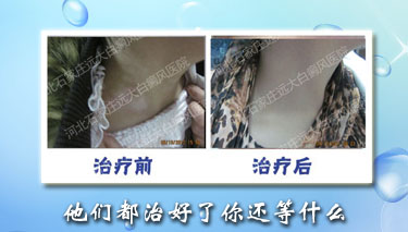 女性頸部早期的白癜風怎么治療