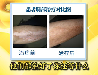 腿部白癜風要治療，哪種方式好
