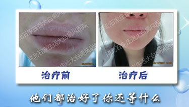 夏季背部白癜風復發怎么辦，怎么預防