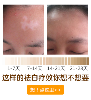頭皮和四肢有白癜風怎么辦