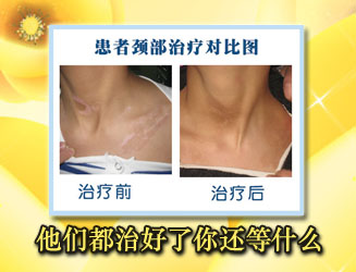 頸部有塊白斑怎么治療