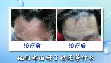 額頭上長了白癜風(fēng)可以治療嗎