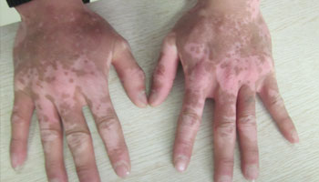 手部白癜風能不能做黑色素移植手術