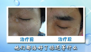 植皮治療白癜風是怎么計費的