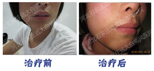 西醫夏季治療白癜風需要多久