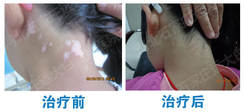 頸部白癜風(fēng)應(yīng)該怎么治療效果好