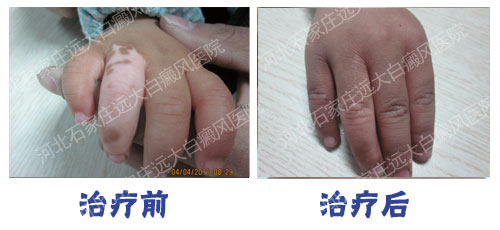 黑色素種植治療白癜風行不行