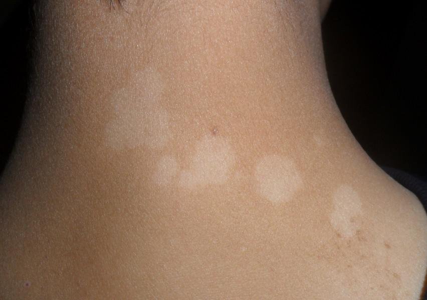 白癜風植皮是從身體別的地方截取嗎