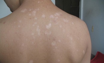 頸部白癜風(fēng)患者選擇哪種手段治療好