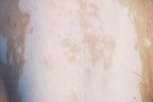 散發(fā)型白癜風(fēng)怎樣治療效果好呢