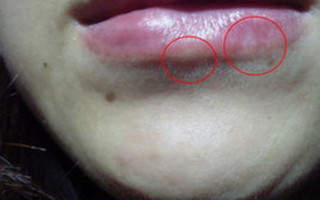 冬季治療白癜風(fēng)