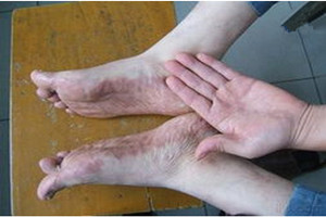 激光治療白癜風怎么樣