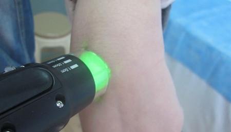 背部白癜風(fēng)早期做激光能控制嗎