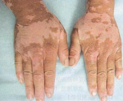 手上大面積白癜風(fēng)好治嗎