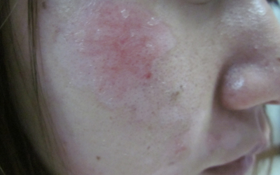 頸部白癜風(fēng)患者選擇哪種手段治療好